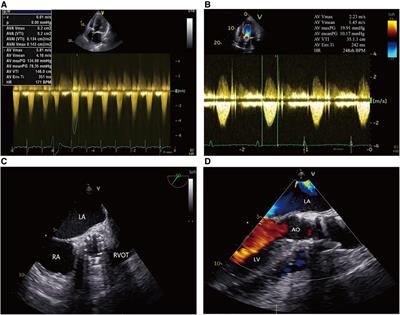 One-stop interventional procedure for bicuspid aortic stenosis in a patient with coexisting aortic coarctation: a case report